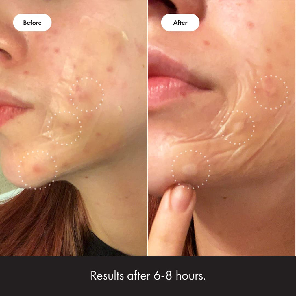 Hero Cosmetics - Mighty Patch Surface - 10 Strip(s)