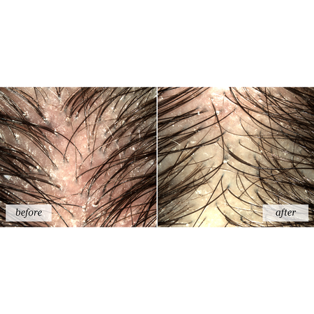 rf_headspa_asterafresh_before-after_1